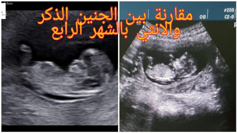 نزول المشيمة في الشهر الخامس