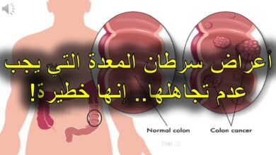 اعراض سرطان المعدة والقولون