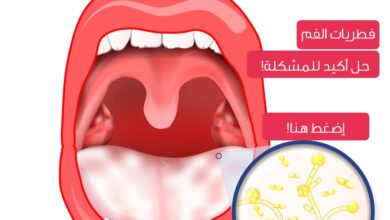 علاج الفطريات في الفم