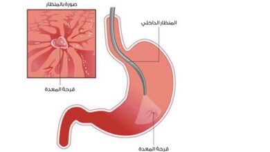 دواء قرحة المعدة