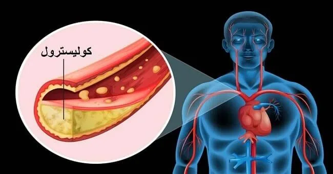 ارتفاع الكويسترول