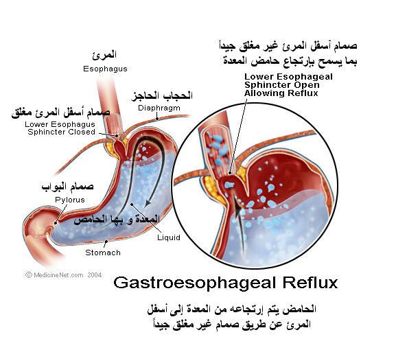 عقاقير حموضة المعدة 