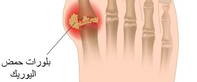 علاج النقرس طبيعيا 
