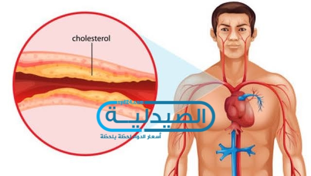 علاج ارتفاع الكوليسترول في الدم