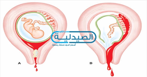 طرق الإجهاض في فترات الحمل المختلفة