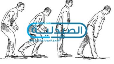 علاج مرض باركنسون