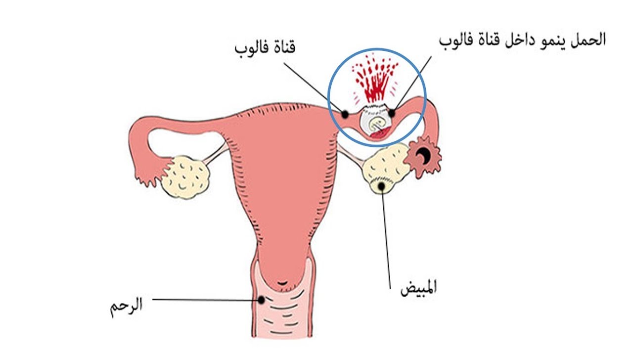 الجنين خارج الرحم