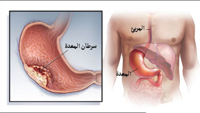 علاج سرطان المعدة