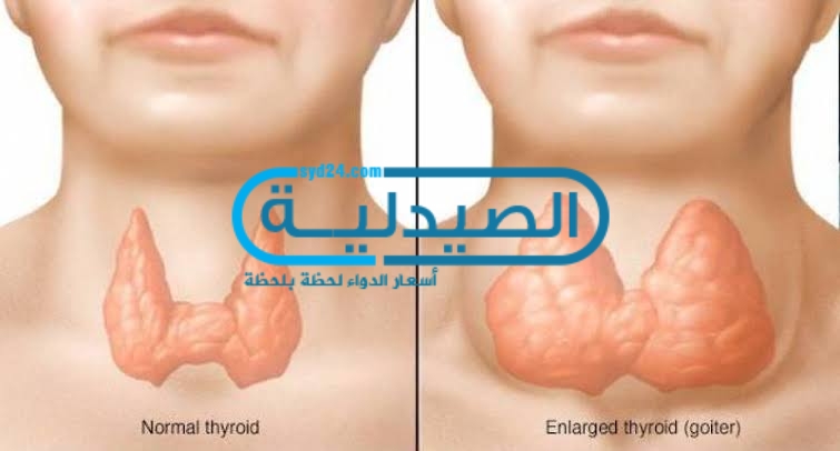 أورام الغدة الدرقية