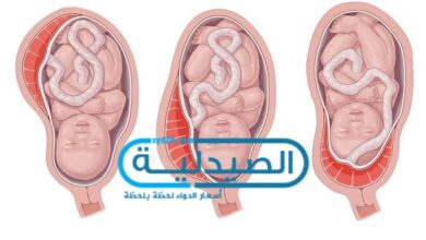 الوضع الطبيعي لـ المشيمة