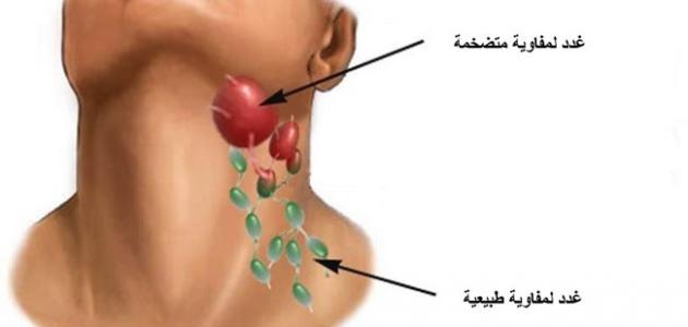 اسباب تورم الغدد اللمفاوية 