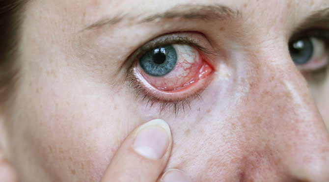 اسباب سرطان العين