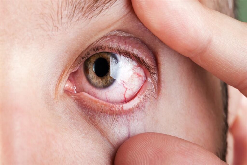 اعراض سرطان العين