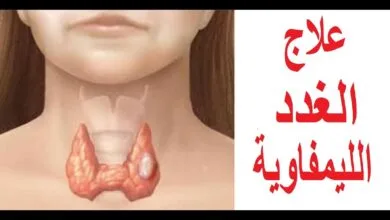 علاج تورم الغدد اللمفاوية