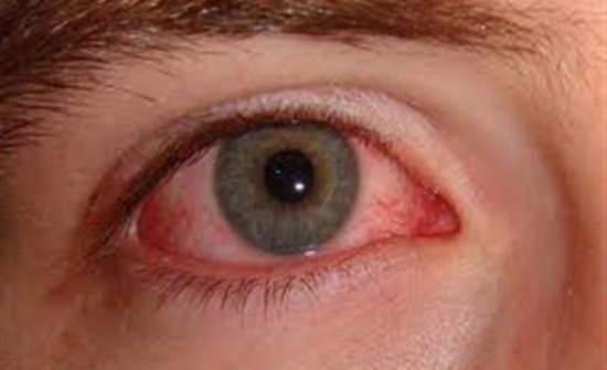 علاج سرطان العين