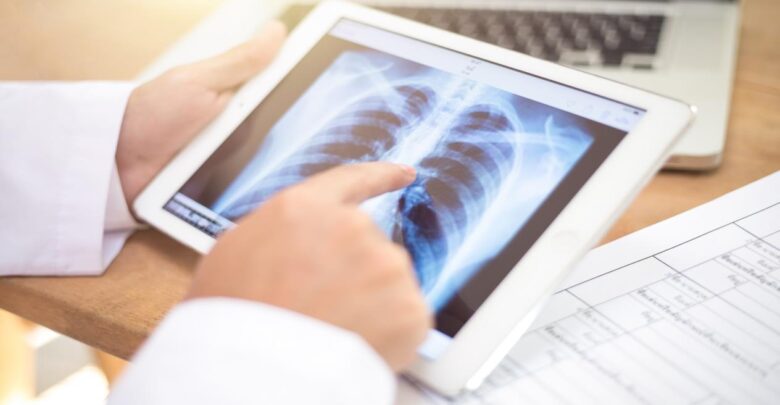 معلومات عن مرض سرطان الرئة