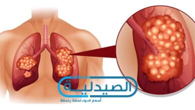 سرطان الرئة