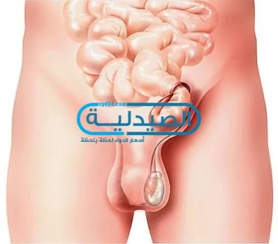 علاج الفتق الاربي وأسبابه وأعراضه ومتى تزور الطبيب وكيفية تشخيصه الفتق الاربي