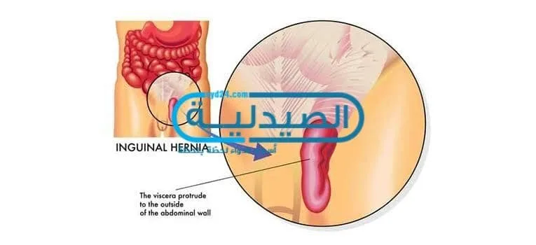 علاج الفتق الاربي وأسبابه وأعراضه ومتى تزور الطبيب وكيفية تشخيصه الفتق الاربي