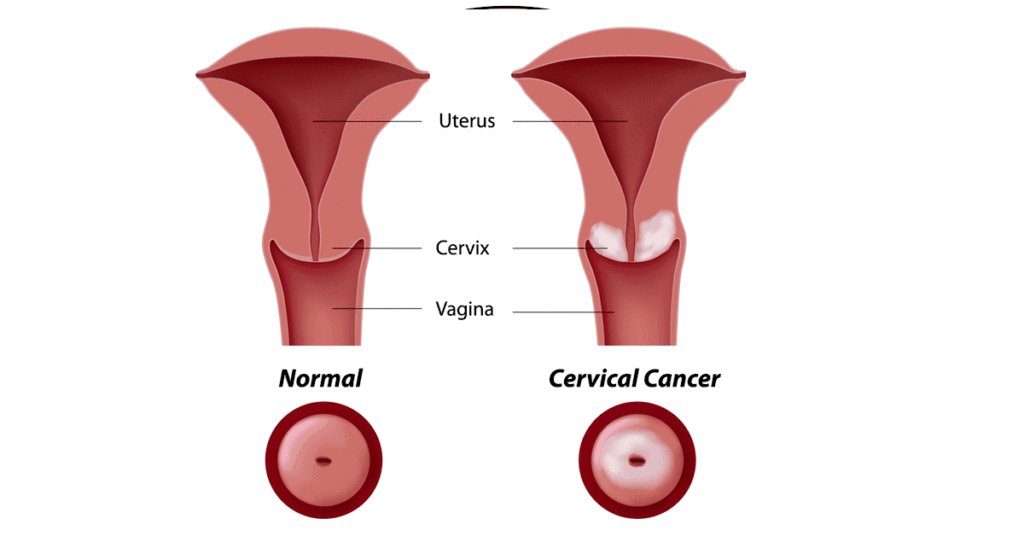 مضاعفات سرطان عنق الرحم