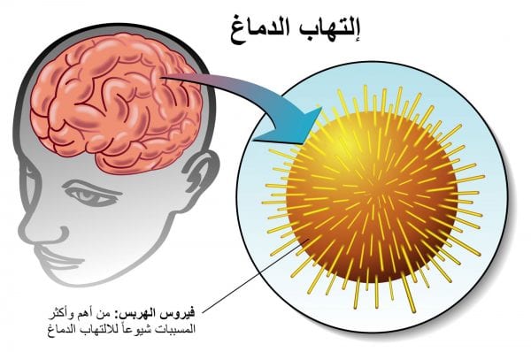 أعراض التهاب اعصاب الرأس والرقبة