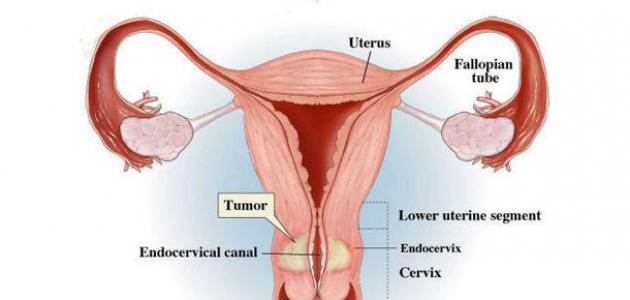 سرطان عنق الرحم