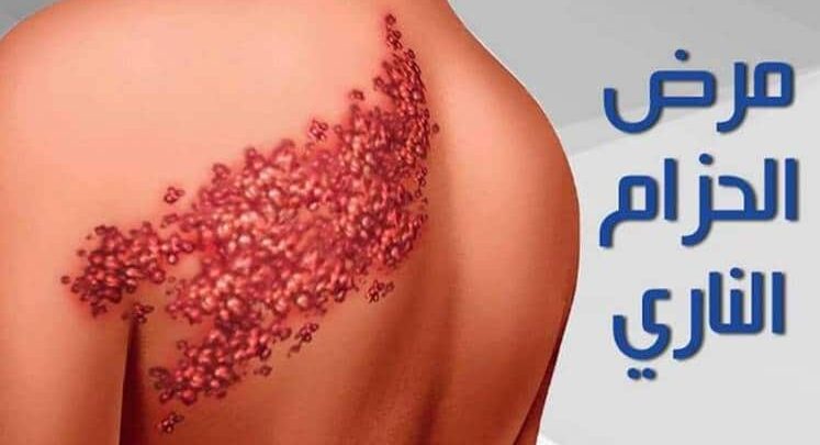أفضل مرهم لعلاج الحزام الناري