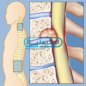 أعراض أورام العمود الفقري