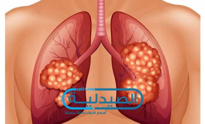 أعراض أورام الرئتين
