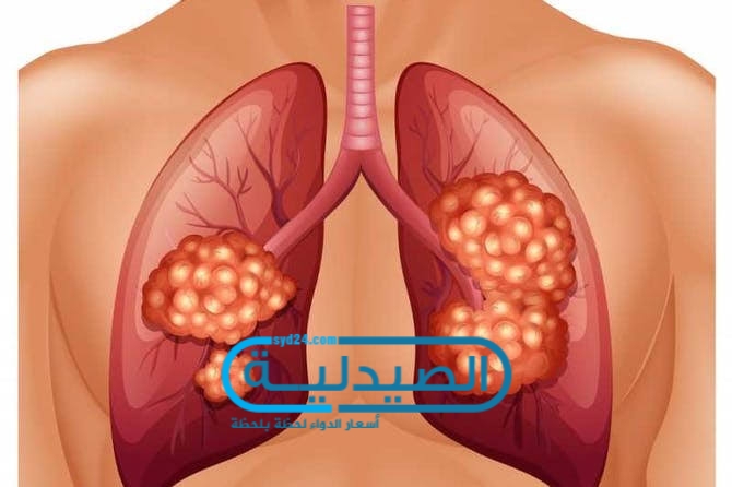 أعراض أورام الرئتين