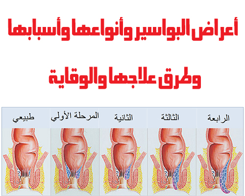 البواسير والحمل