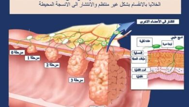 مراحل السرطان