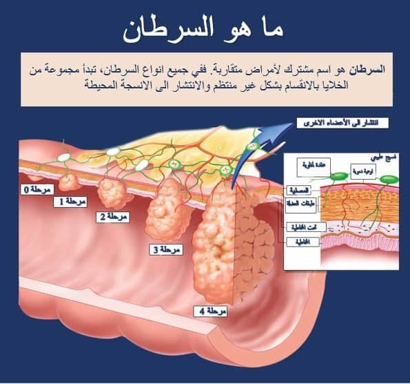 مراحل السرطان