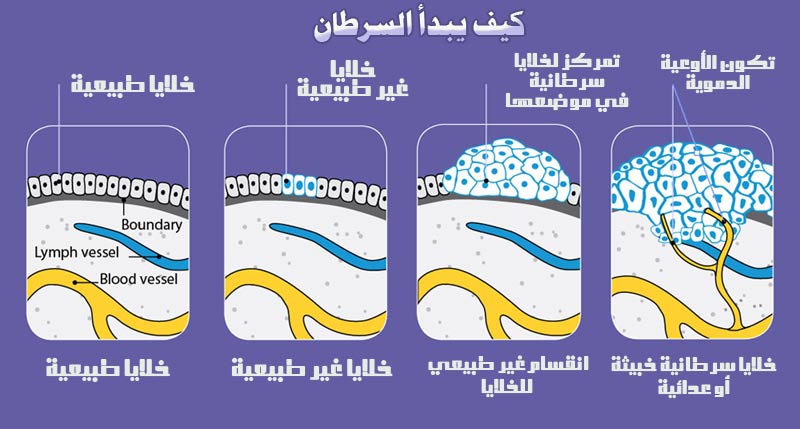 عوامل الإصابة بالسرطان