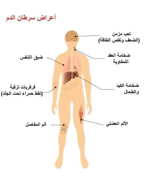ما هي أعراض سرطان الدم ؟