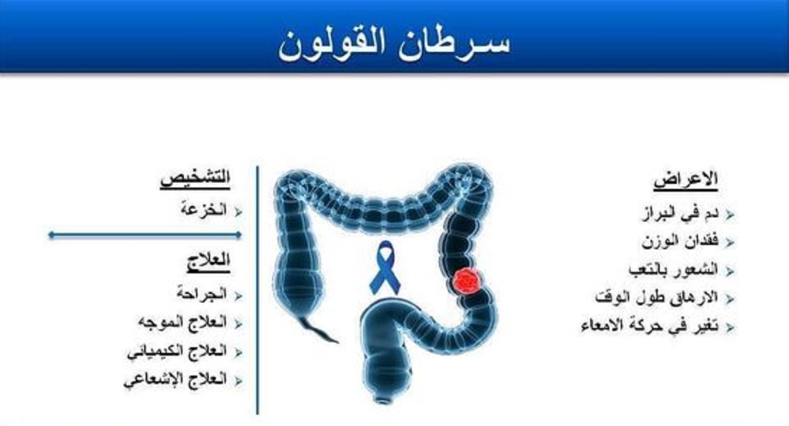 تشخيص وعلاج سرطان القولون