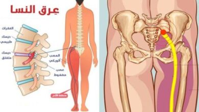 أسباب الإصابة بـ عرق النسا