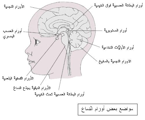 أنواع أورام الدماغ