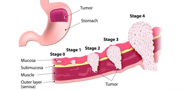 تطورات سرطان المعدة