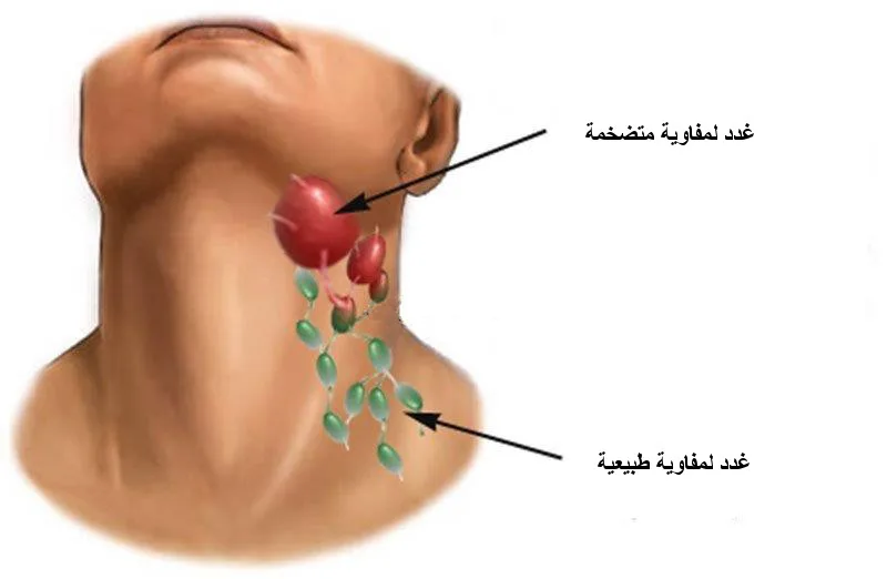 غدد لمفاوية