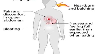أسباب وأعراض عسر الهضم