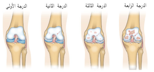 درجات خشونة المفاصل