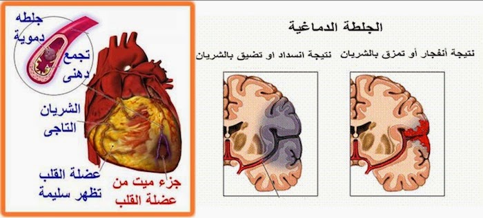 كيف تحدث الجلطة الدماغية ؟