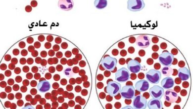 كيف يصبح شكل الخلايا المصابة بـ اللوكيميا ؟