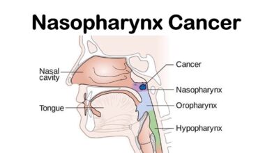 أسباب سرطان البلعوم الأنفي