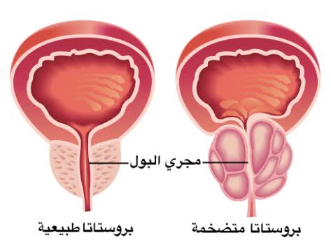 الفرق بين البروستاتا الطبيعية والبروستاتا المتضخمة