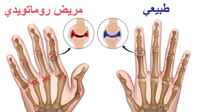 الفرق بين الحالة الطبيعية لـ العظام و الإصابة بـ الروماتويد