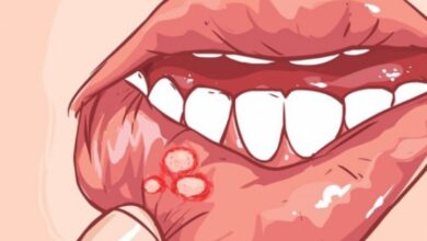 أسباب الإصابة بـ فطريات الفم