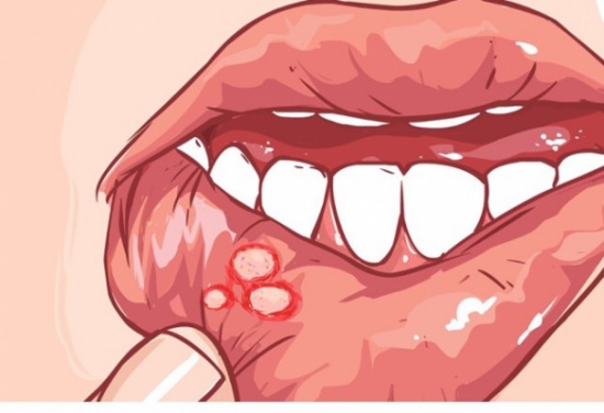 أسباب الإصابة بـ فطريات الفم