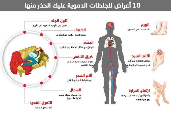 أعراض الجلطات الدموية